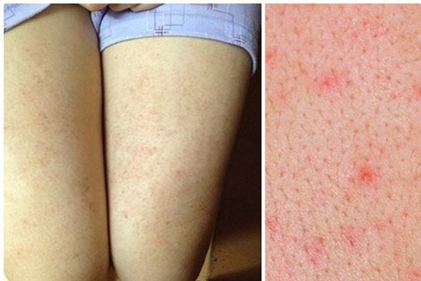 cach chua viem nang long o chan 1