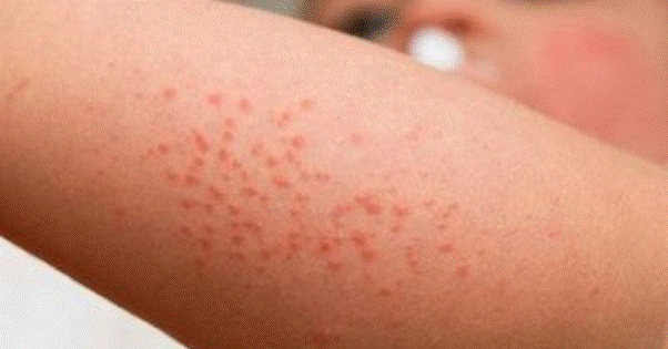 cach chua viem nang long o tay