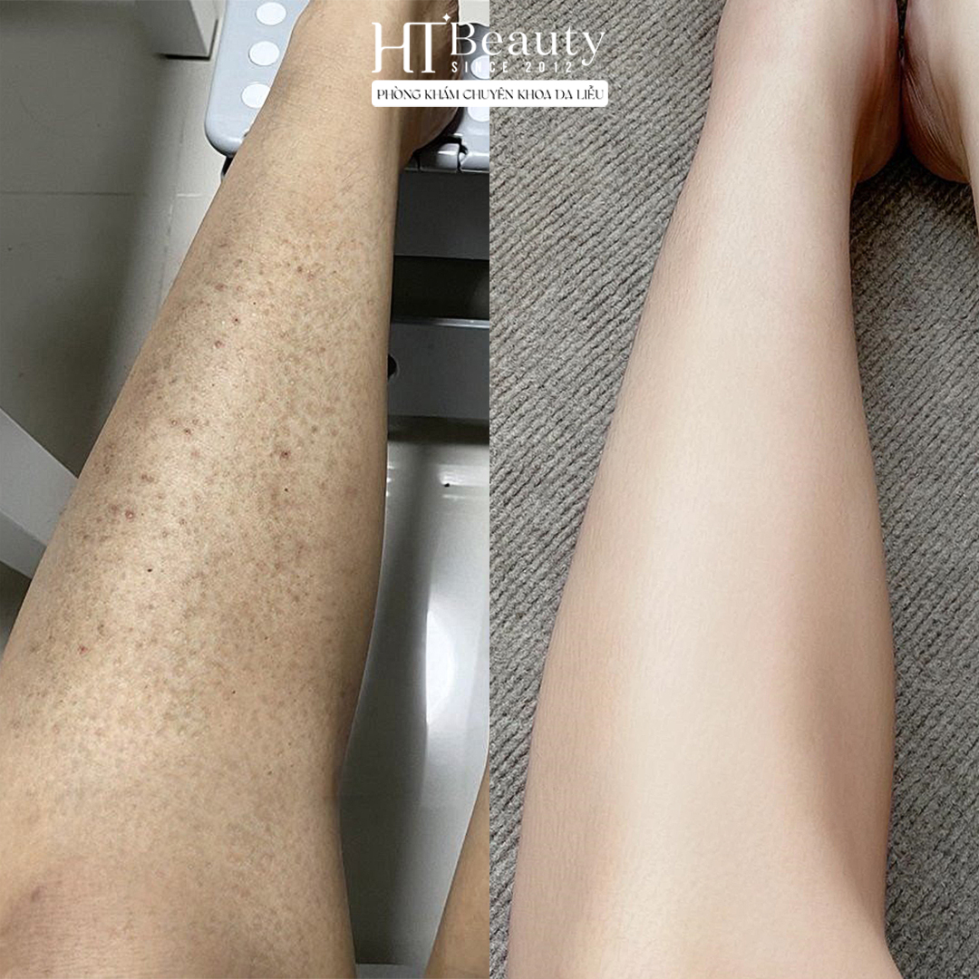 viem nang long chan bf