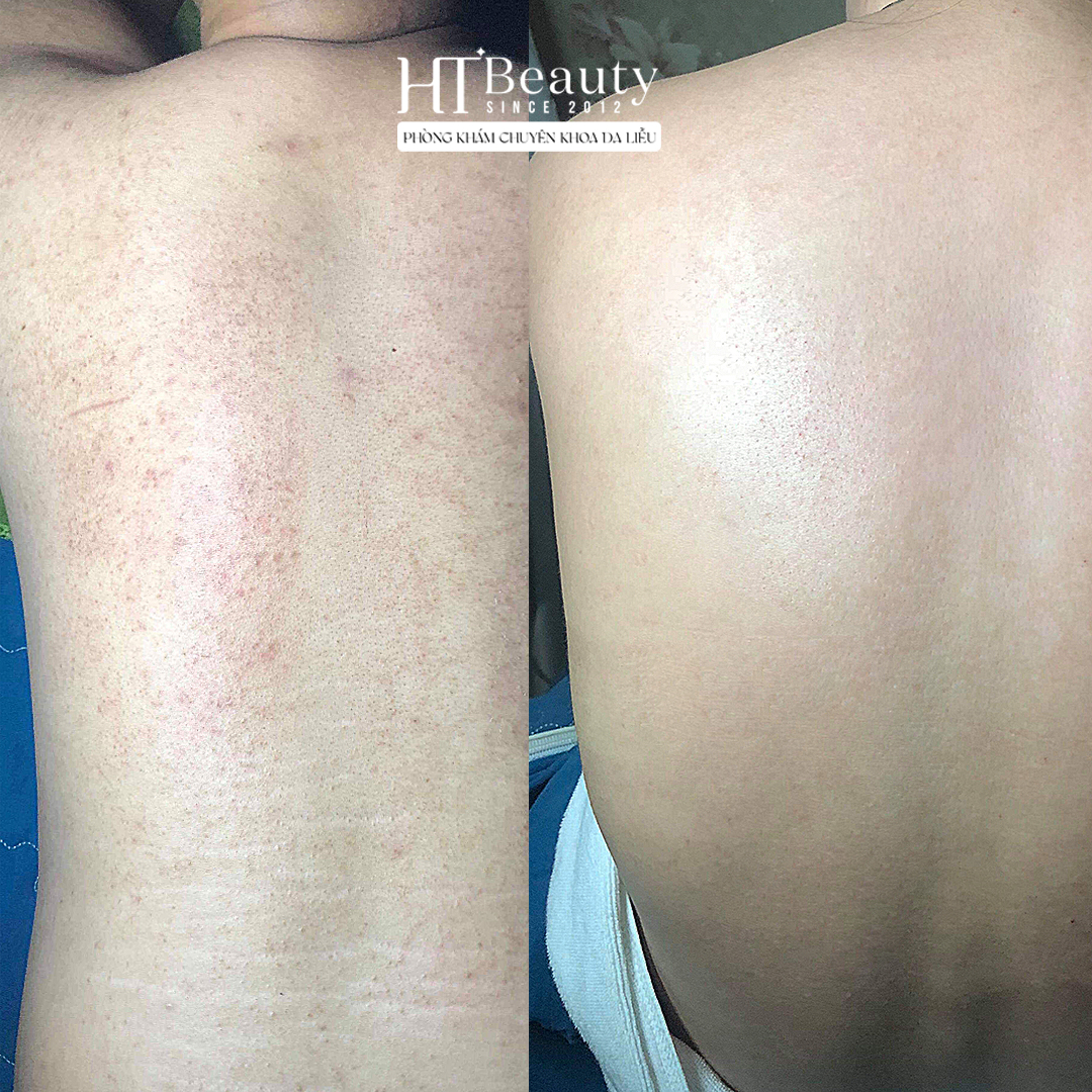 viem nang long o lung bf