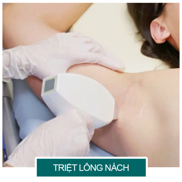 Triệt lông tay chân vĩnh viễn: Lợi ích và lưu ý