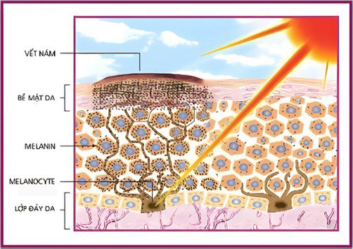 nam kho tri dut diem