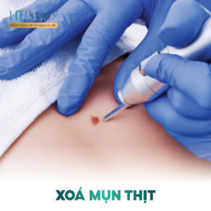 Xoá Mụn Thịt