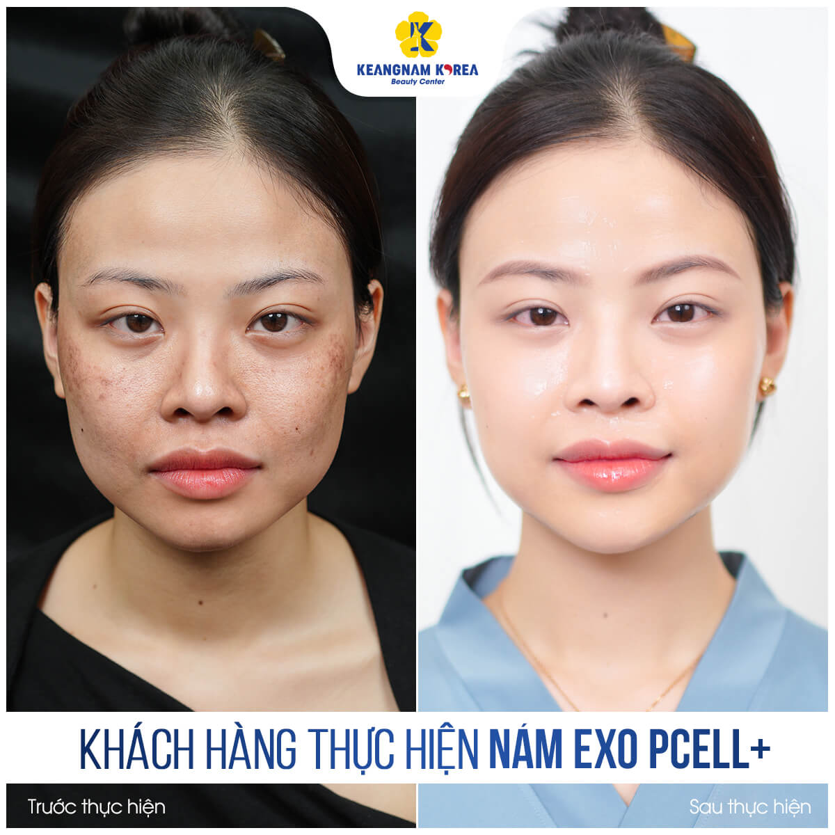 BF AF khach hang tri nam exo pcell 3