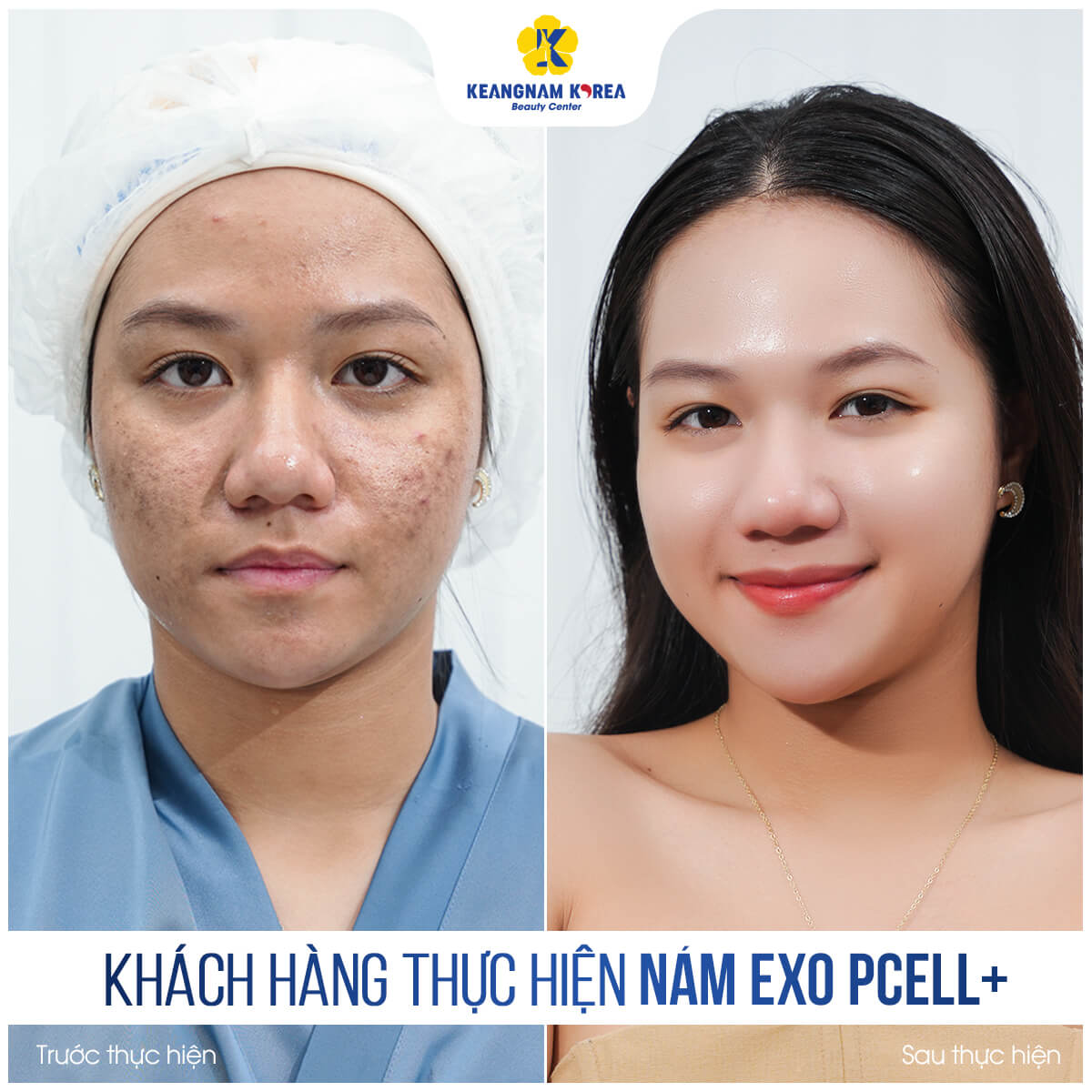 BF AF khach hang tri nam exo pcell 4