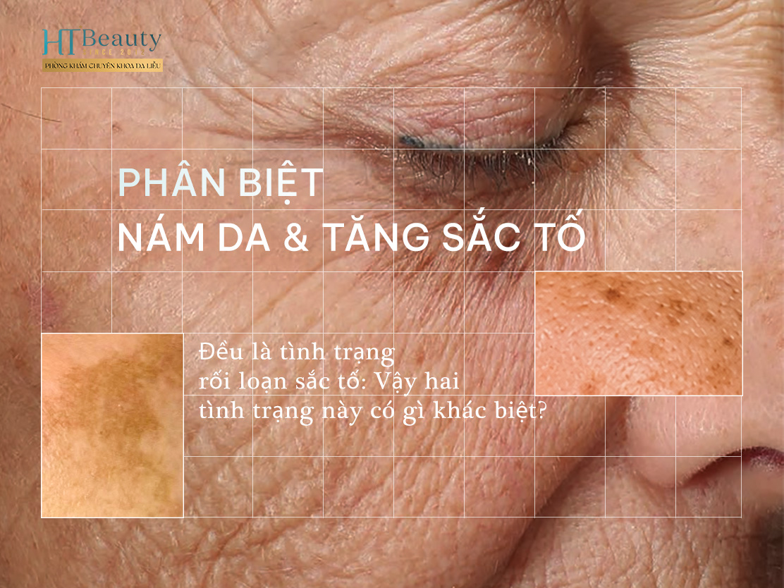 Phan biet Nam da va Tang sac to sau viem Nham lan pho bien trong dieu tri roi loan sac to2 1