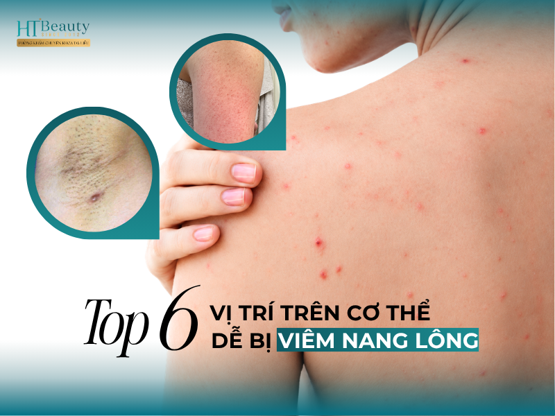 Top 6 vị trí dễ bị viêm nang lông trên cơ thể