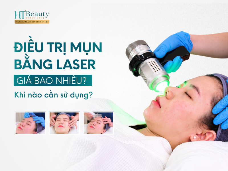 Điều trị mụn bằng laser giá bao nhiêu?